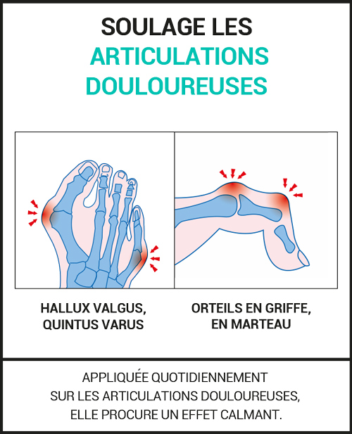 Crème apaisante pour les articulations sensibles, notamment l’Hallux Valgus