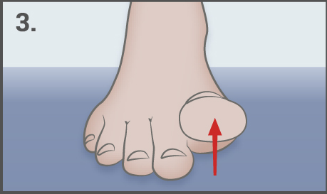 The first-toe extension - hallux valgus