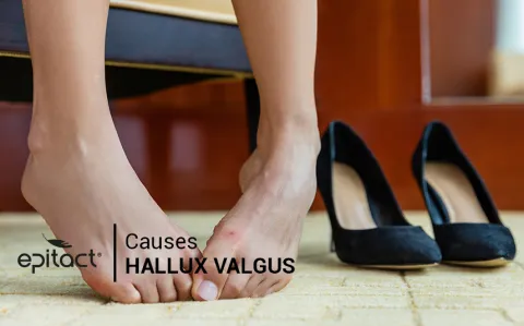 Causes de l'hallux valgus ou oignon au pied