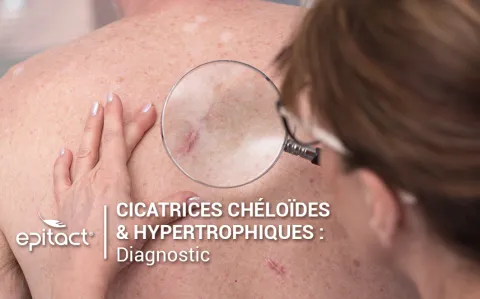 Diagnostic d’une cicatrice hypertrophique ou chéloïde