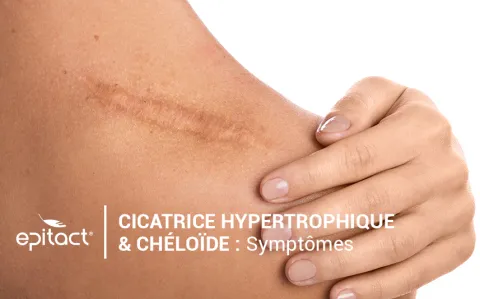 Symptômes des cicatrices chéloïdes et hypertrophiques