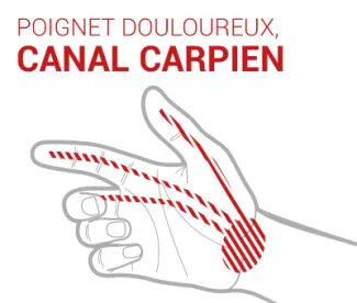syndrome-canal-carpien-epitact
