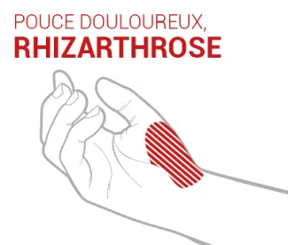 rhizarthrose-pouce-orthèses-epitact