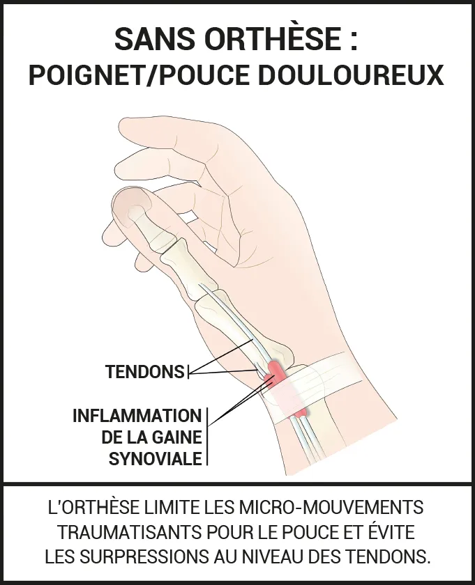 Orthèse d'activité pour tendinite de De Quervain - Epitact