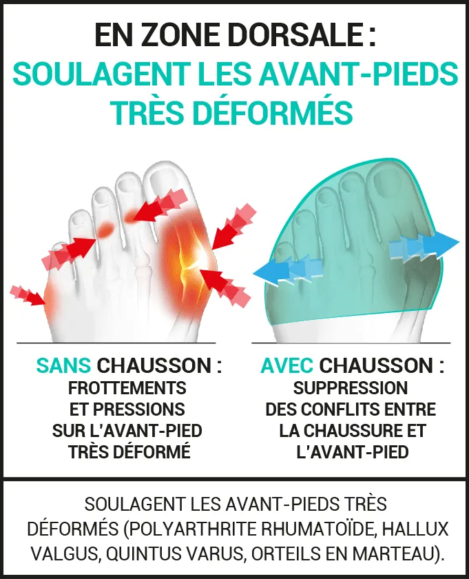 douleurs plantaires Hallux valgus Quintus varus orteils en marteau