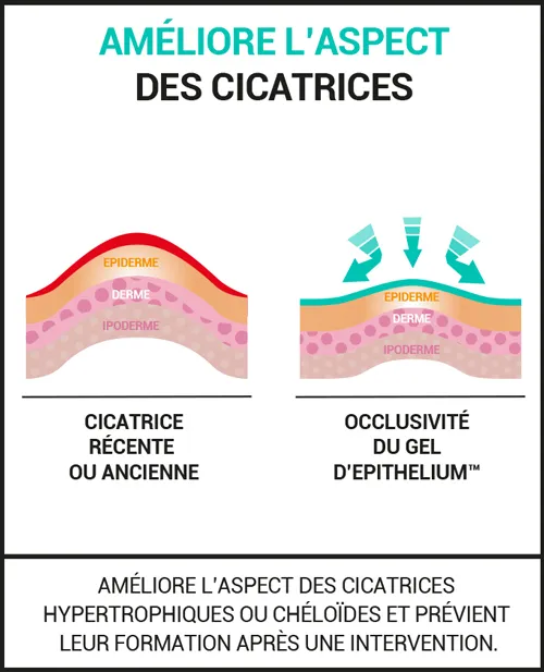 Améliore l’aspect des cicatrices hypertrophiques et chéloïdes