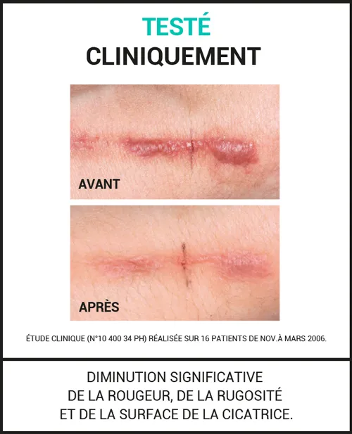 Améliore l’aspect des cicatrices hypertrophiques et chéloïdes
