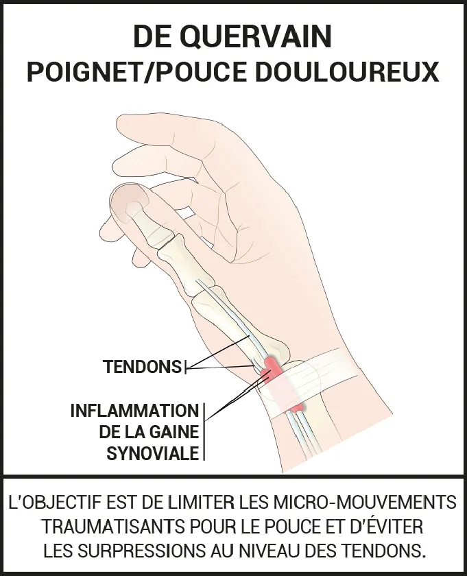 Poignet douloureux tendinite de De Quervain