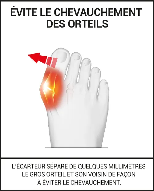 Séparateurs d’orteils pour l’Hallux Valgus