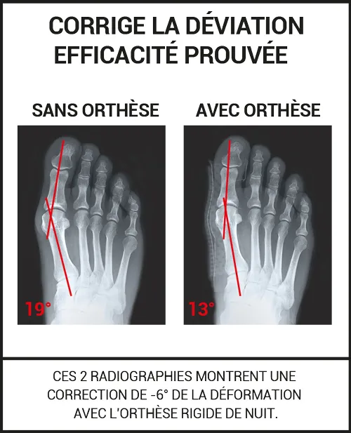 Orthèse Hallux Valgus Nuit