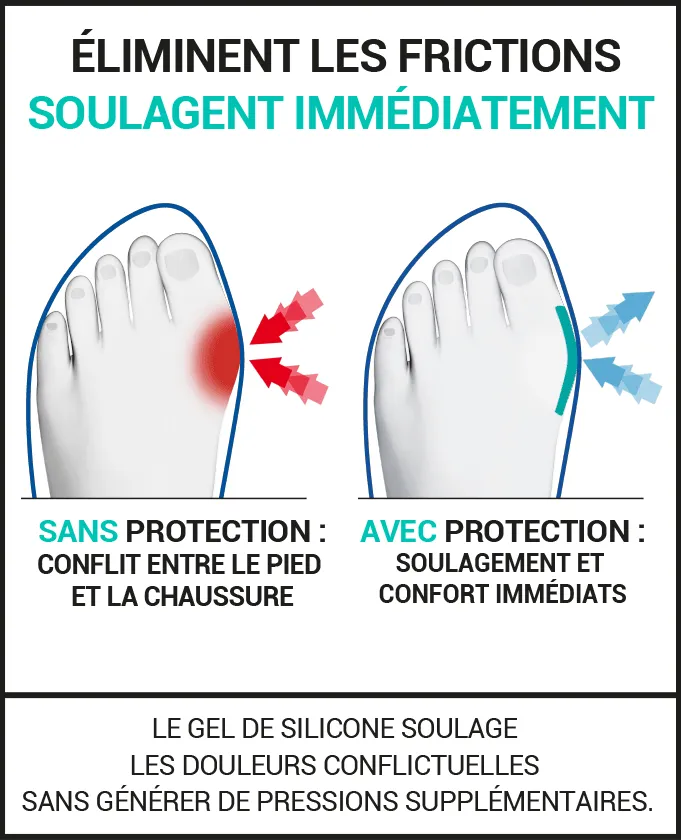 Protections occasionnelles pour l’Hallux Valgus