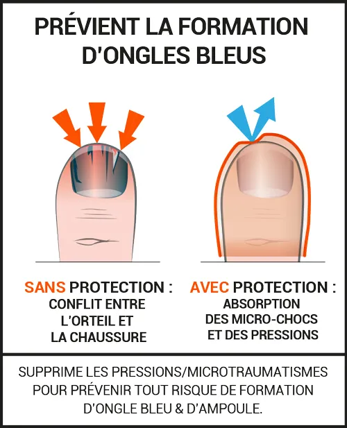 Protections ongles bleus durant la pratique du sport