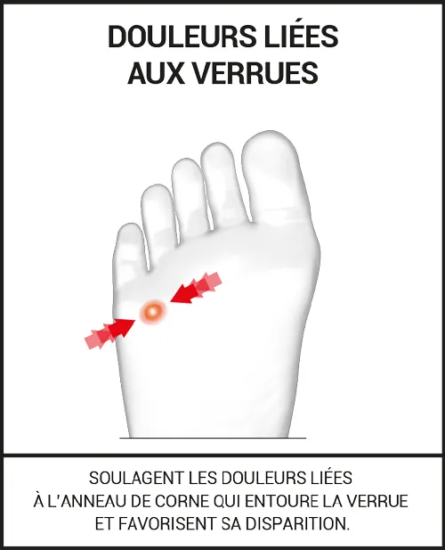 Soulage les douleurs liées aux verrues