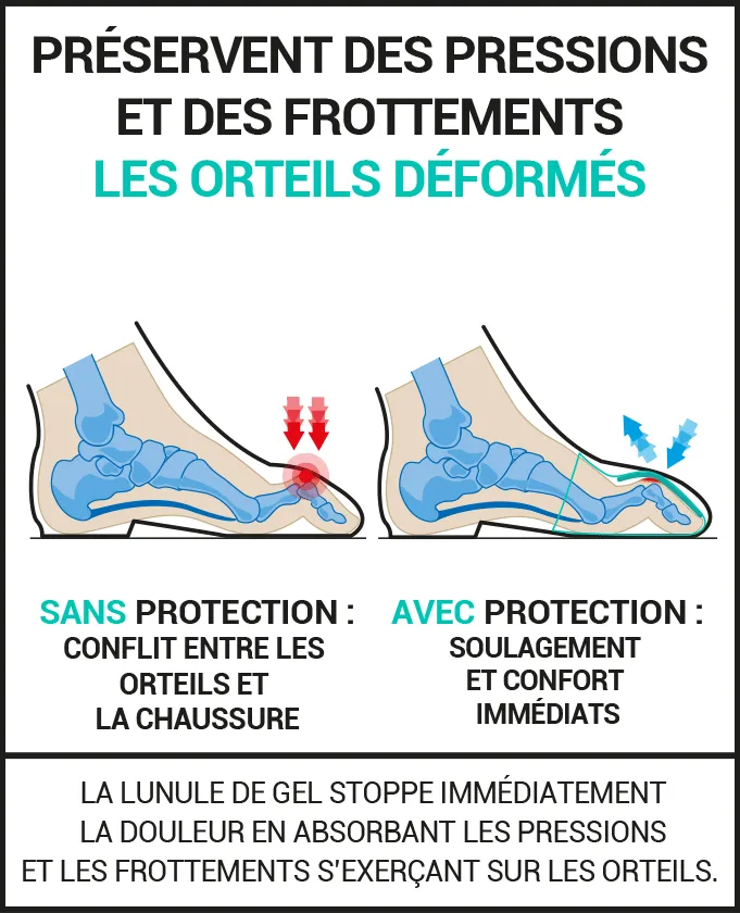 protection-orteils-en-marteau