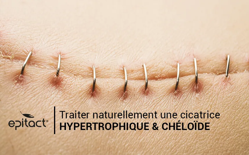 cicatrices EPITACT®