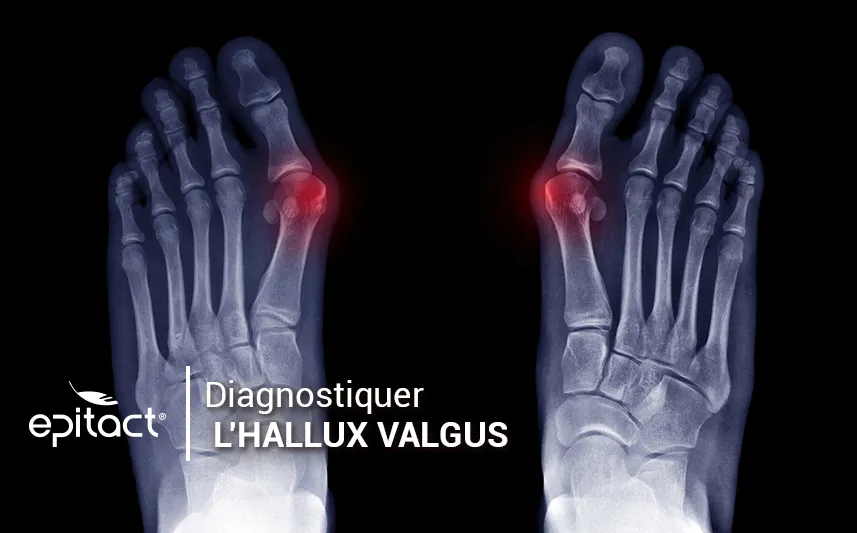 Comment diagnostiquer un hallux valgus ou « oignon »