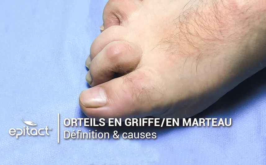 orteils en griffe/en marteau : définition & causes