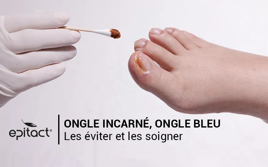 Comment soigner un ongle incarné et un ongle bleu au pied ?